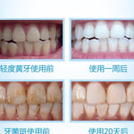 Teeth Whitening Kit